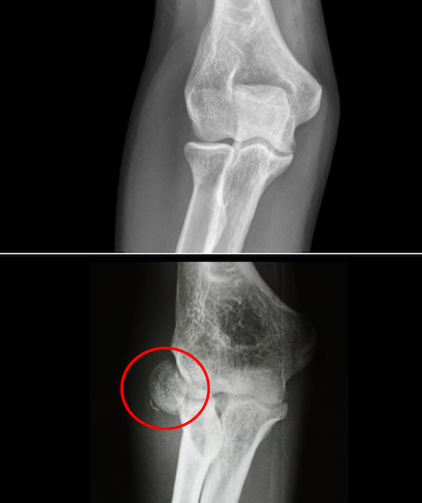 Radial head fracture